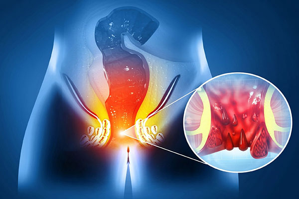 Fissure & Fistula Treatment – Dwarkesh Surgical Hospital