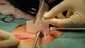 Hernia & Laparoscopic Surgery – Dwarkesh Surgical Hospital