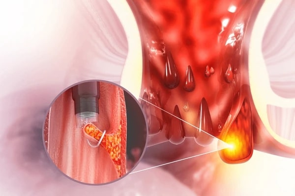 Laser Piles Surgery – Dwarkesh Surgical Hospital